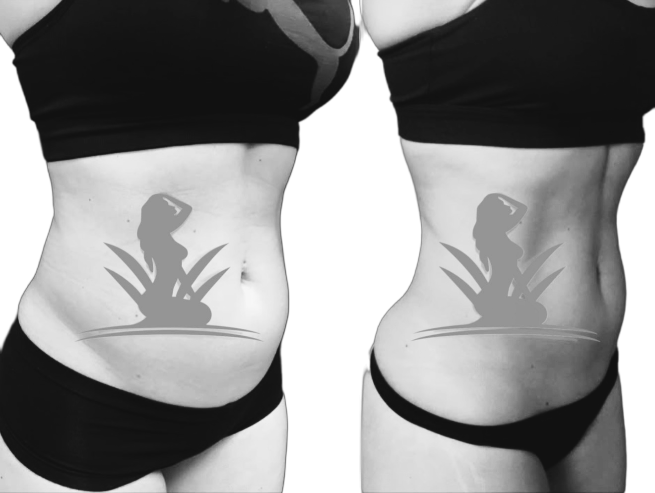 Body Contouring - Results