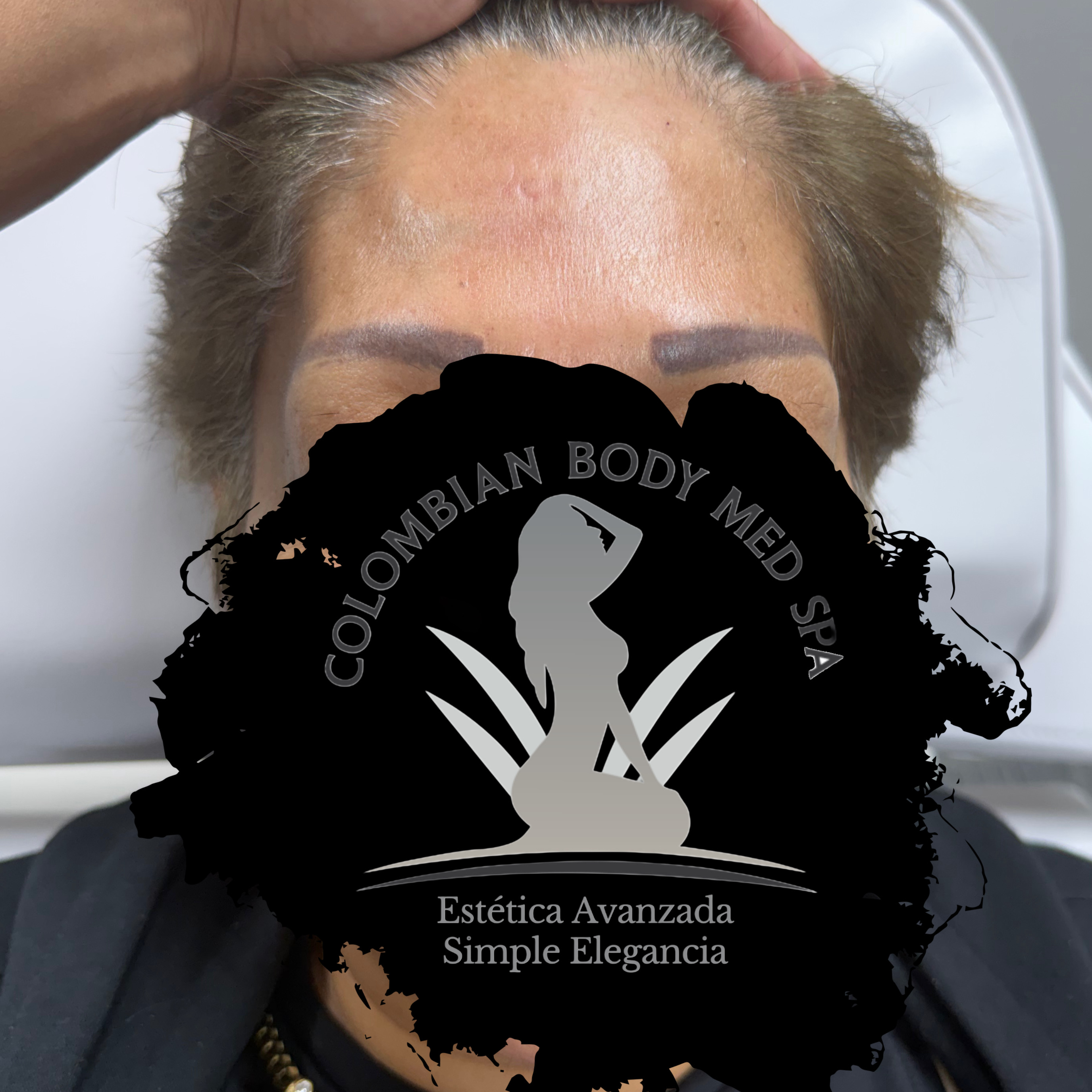 Botox - After