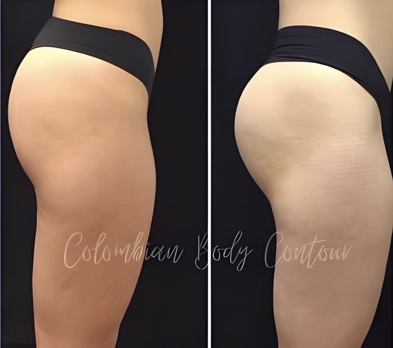 Cellulite Treatment - Results