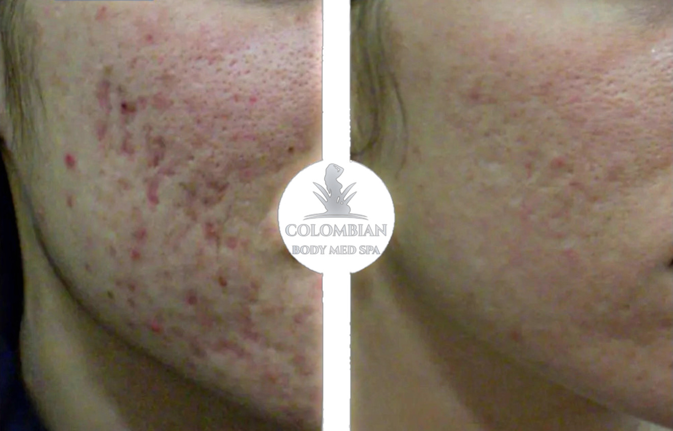 Facial Treatments - Results