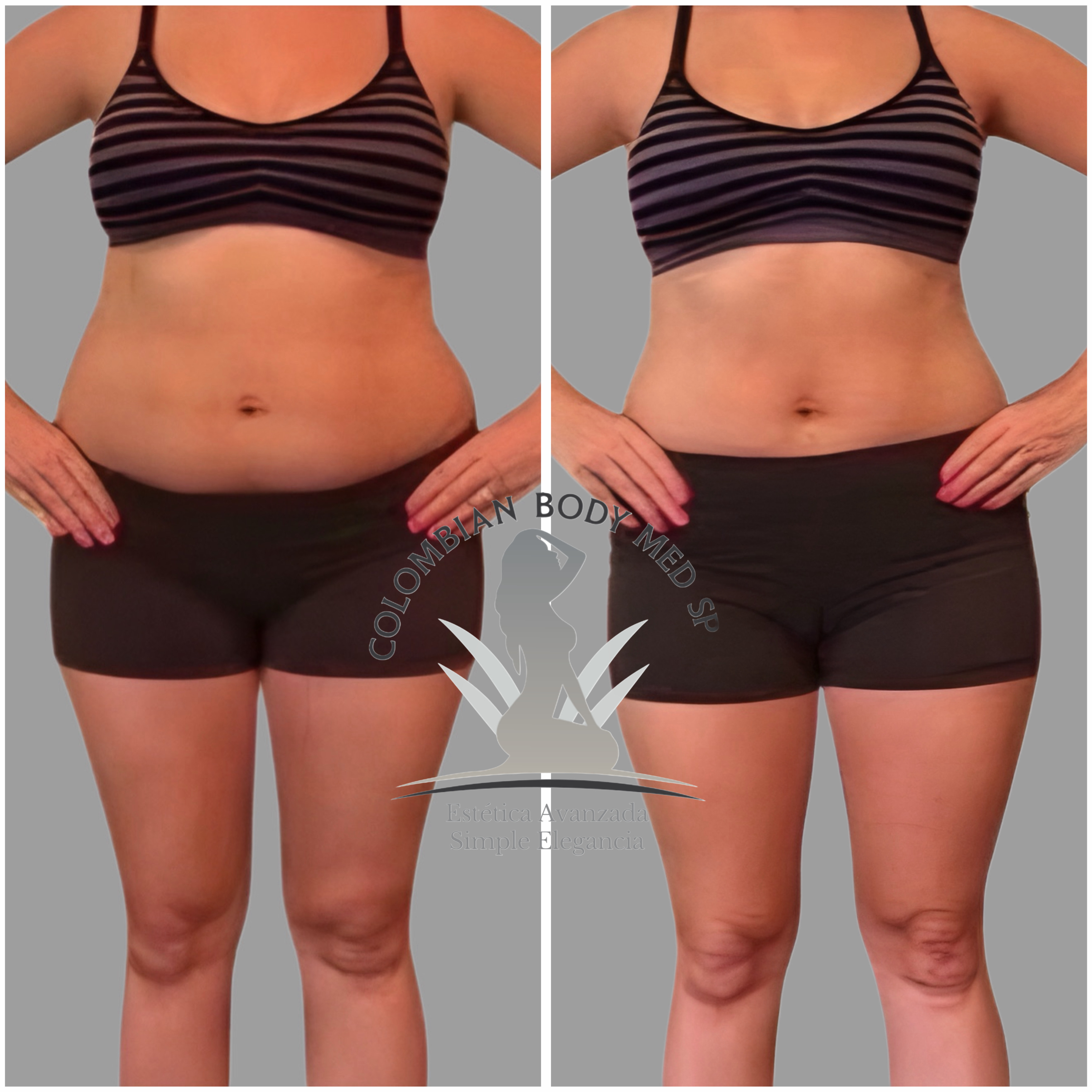 Laser Lipo - Results