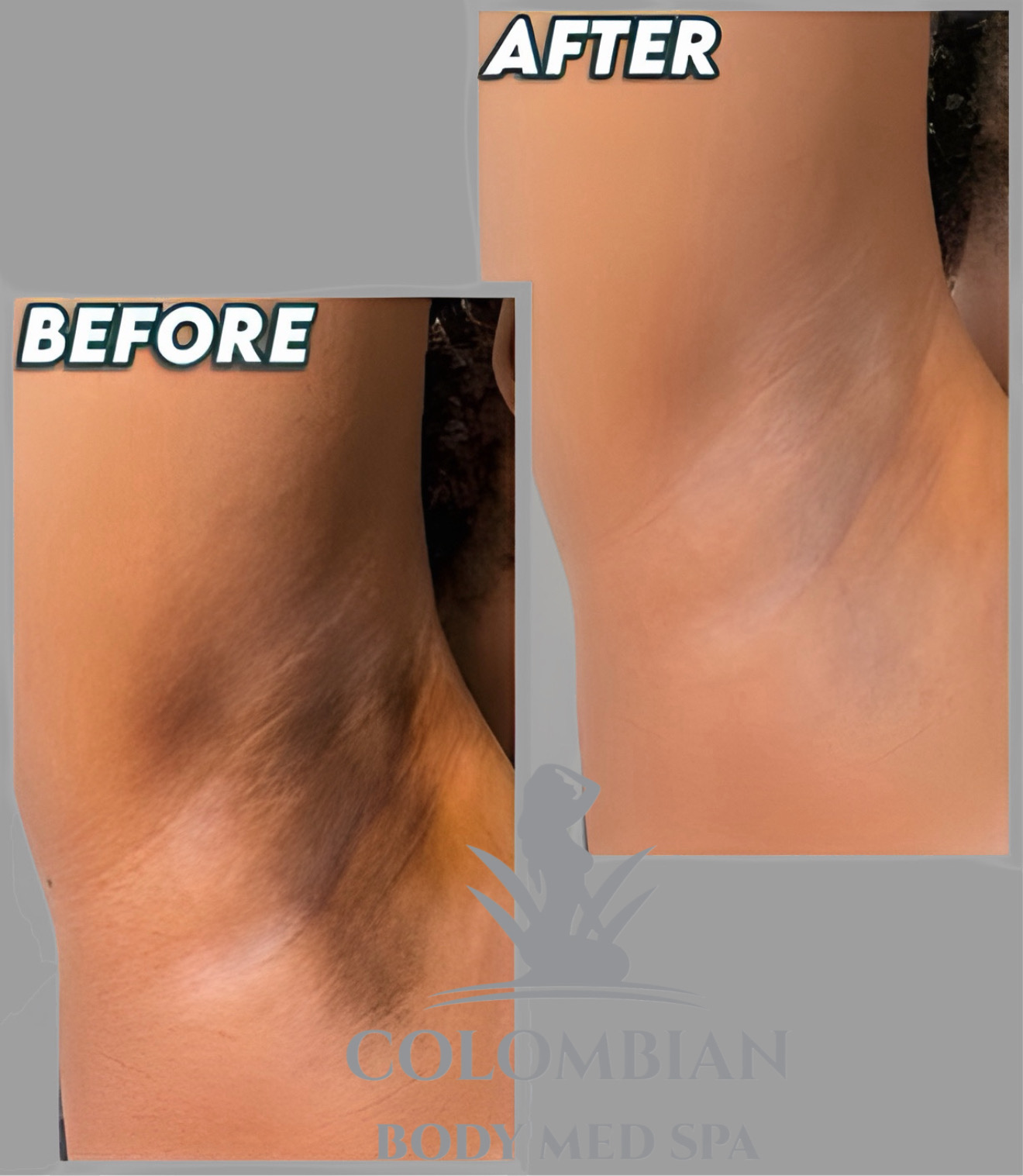 Armpit Skin Lightening - Results